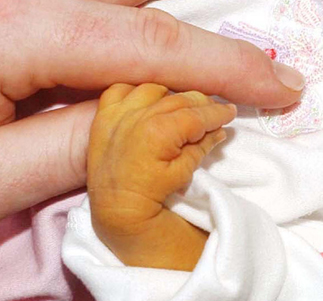 SEVERE JAUNDICE CONDITION